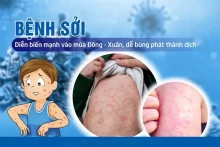 BÀI TUYÊN TRUYỀN PHÒNG CHỐNG BỆNH SỞI